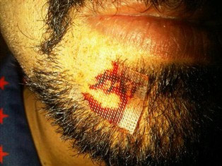 Venky injury turns into sacred 'Om' symbol
